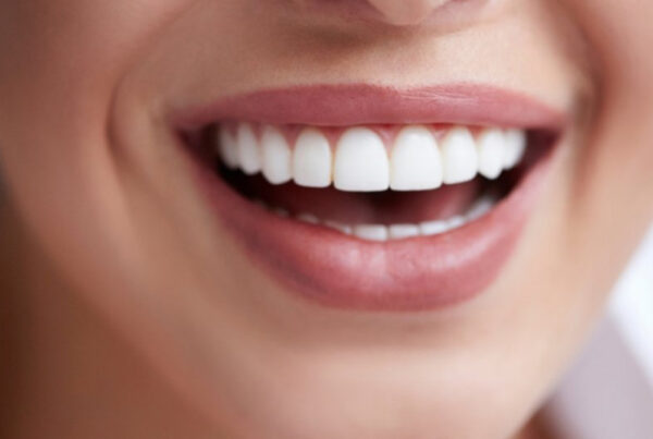 Hollywood Smile
