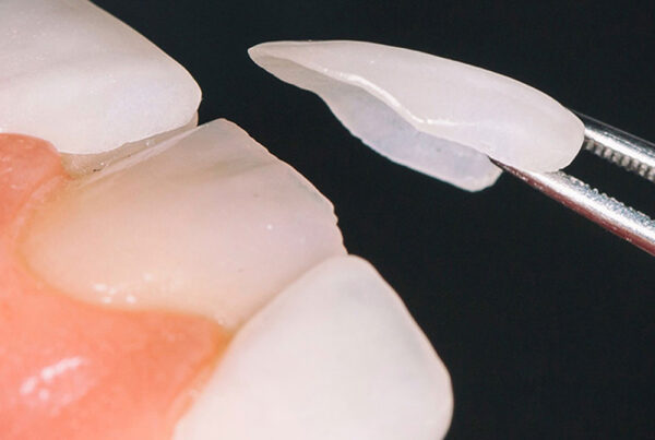 Laminate Veneers