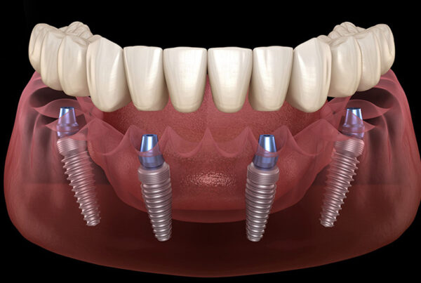 All on 4 Implants