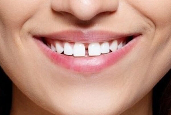 Composite Bonding
