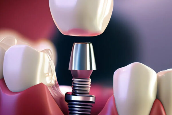 Dental Implants