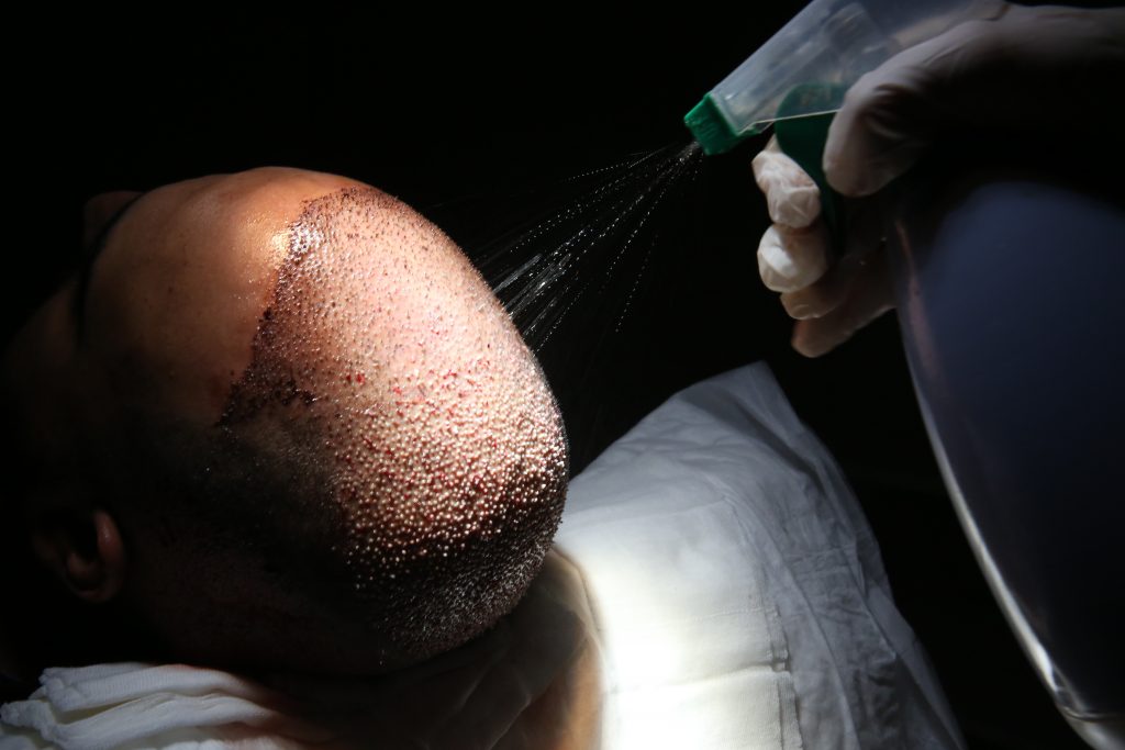 End of a Sapphire-FUE Hair Transplant on a Male Patient