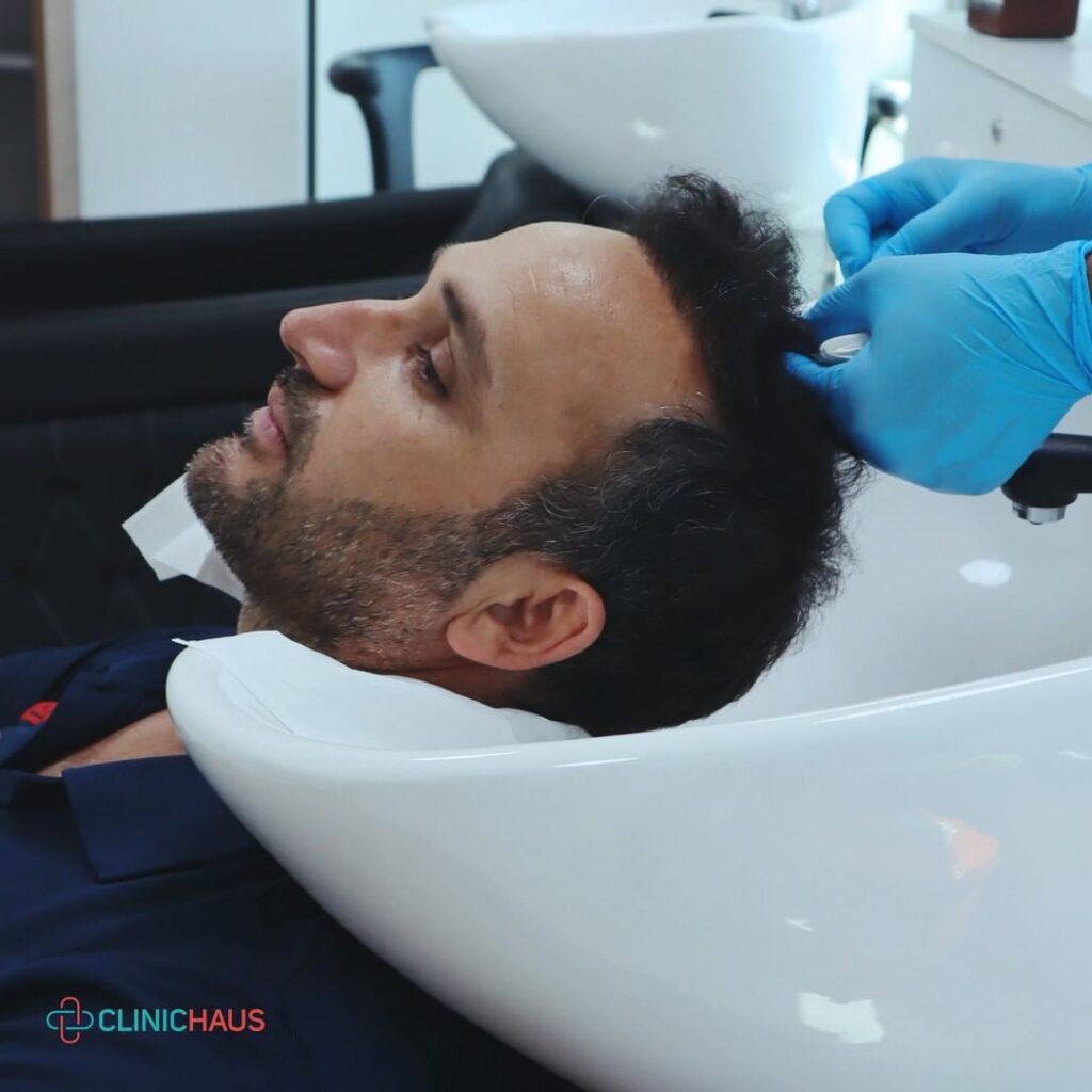 Hair transplant in Turkey