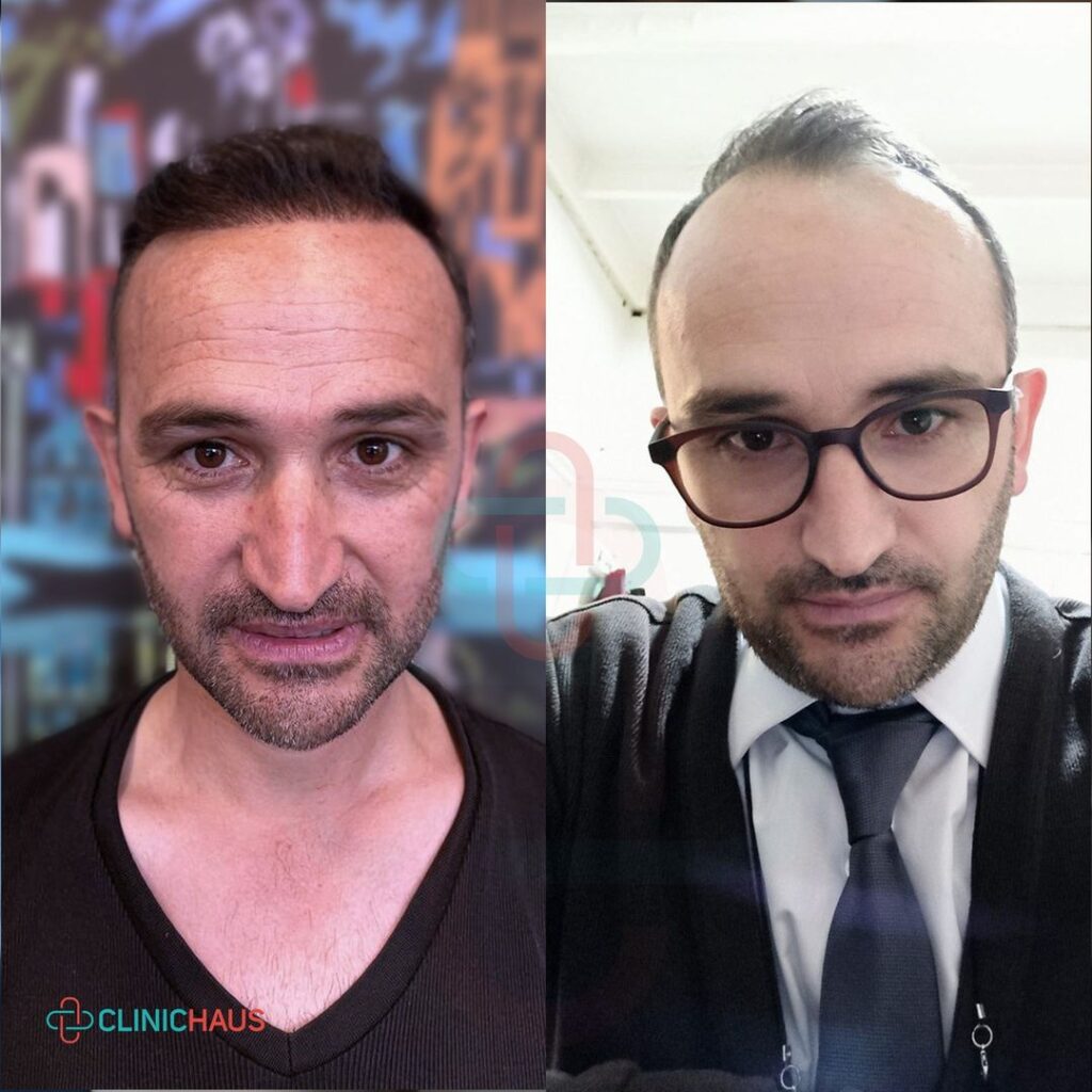 hair transplants before and after