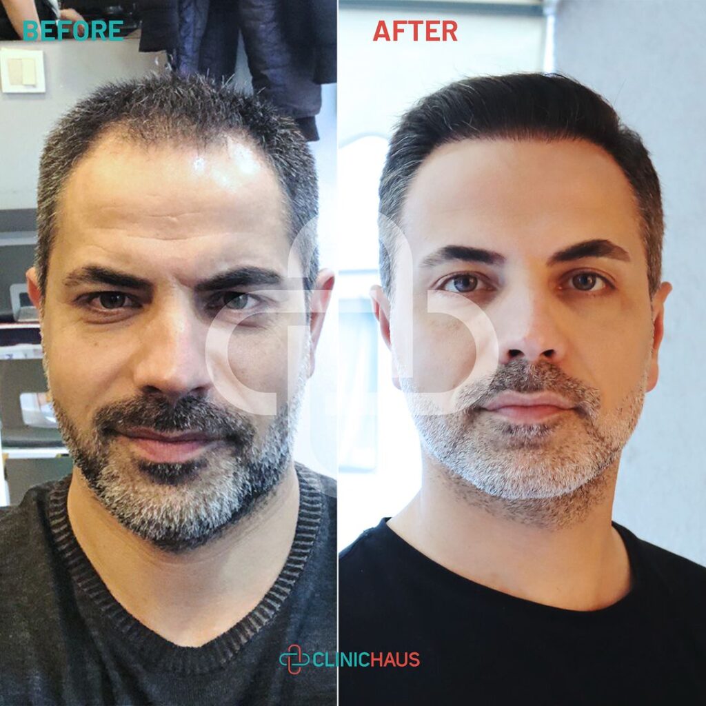 Hair Restoration