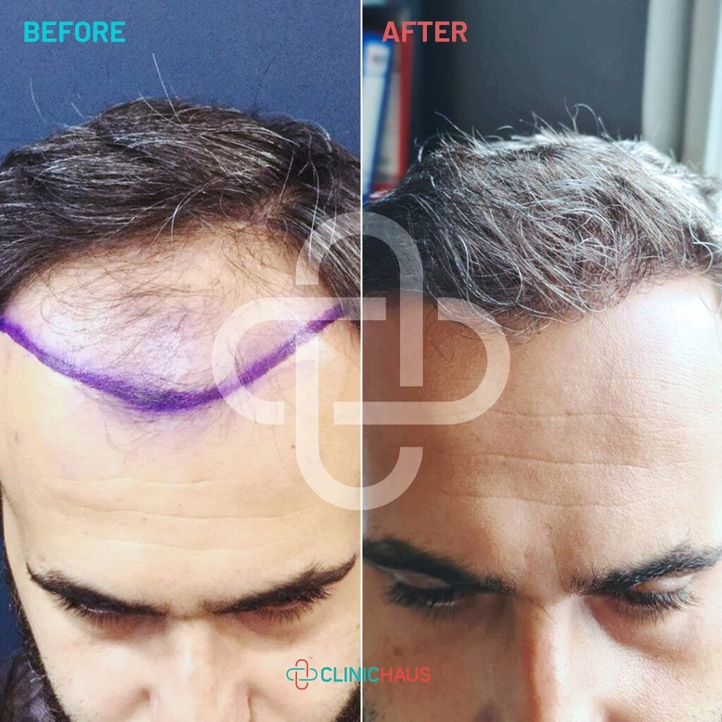 Results of Hair Transplantation