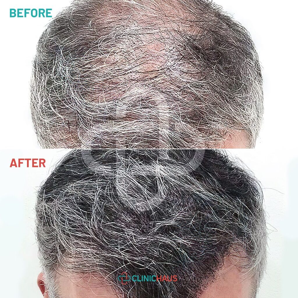 success rate of hair transplant