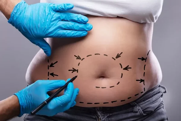 Tummy Tuck