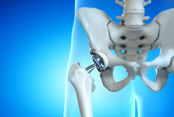 HIP Replacement Surgery