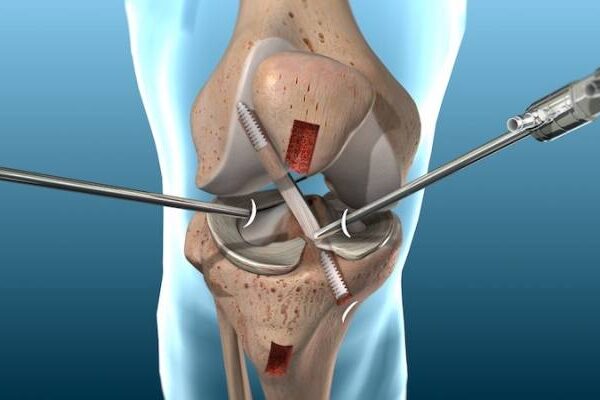 Knee Arthroscopy